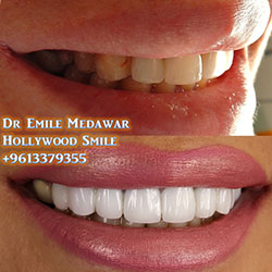 direct veneers