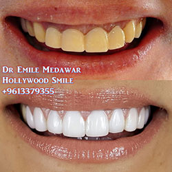 direct veneers