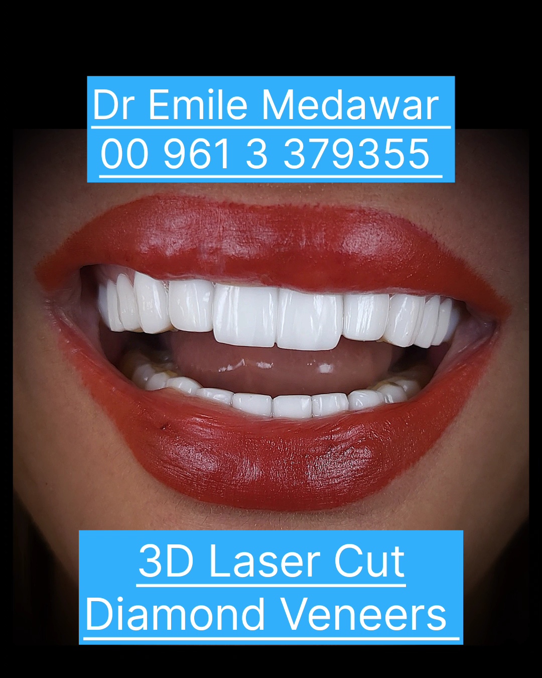 Laser dental implants procedure in Lebanon