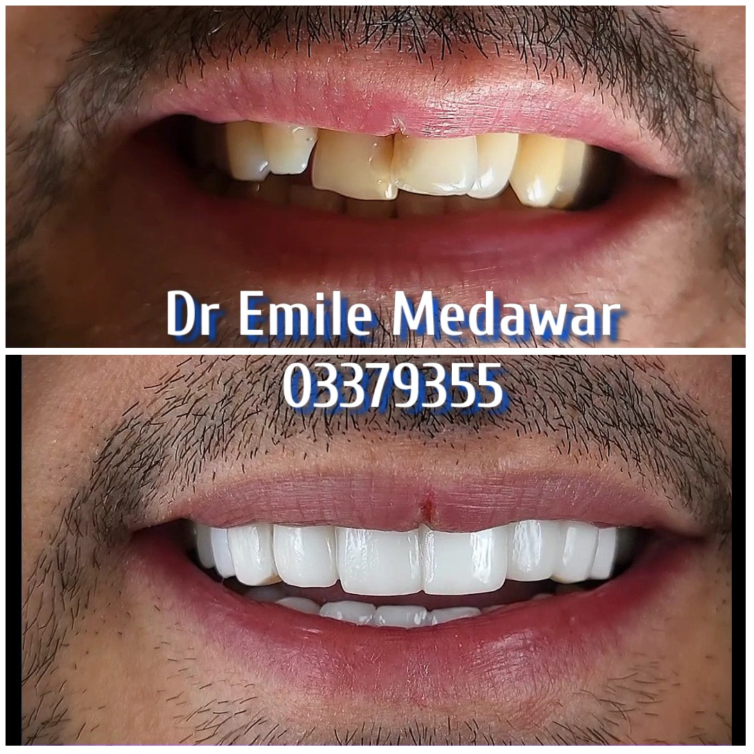 Before and after results of laser dental implants in Lebanon